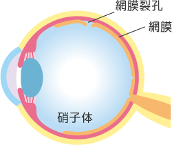 網膜裂孔のイメージ図