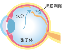 網膜剥離のイメージ図