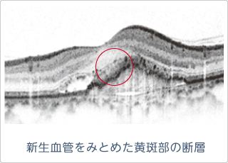 新生血管をみとめた黄斑部の断層のOCT画像