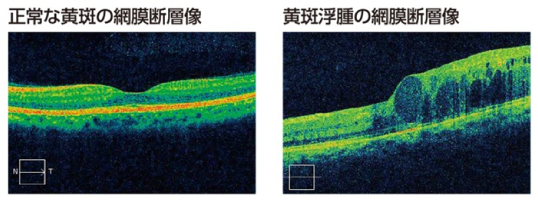 正常な黄斑の網膜断層像と黄斑浮腫の網膜断層像