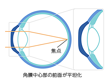 オルソケラトロジーレンズ装用後(裸眼時)の角膜の状態の図